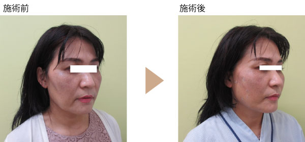 アンカーリフト | 銀座の美容外科・美容皮膚科ならノエル銀座