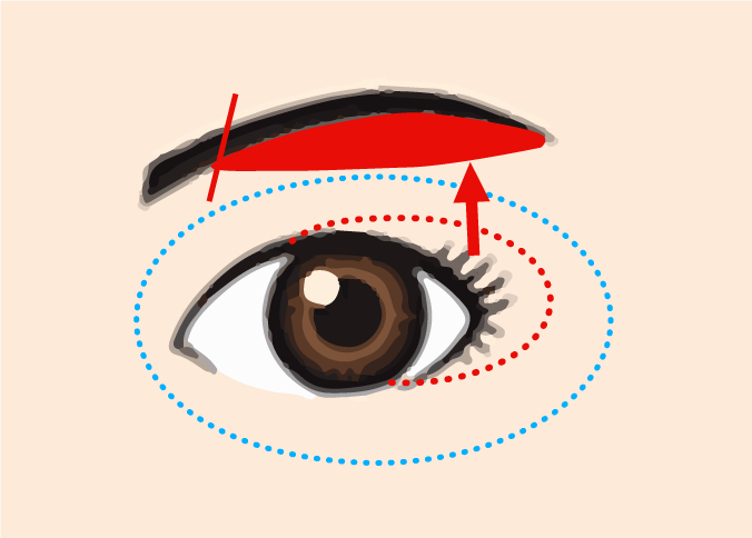 眉下切開術イメージ
