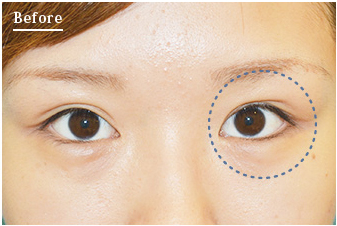 取れ た 埋没 「埋没法、とれたかも？」と思った時に確認すべき４つのコト