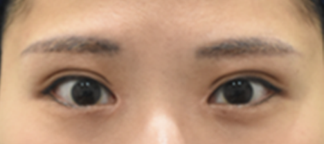 After（2ヶ月後）