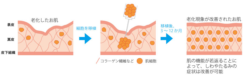 肌再生治療