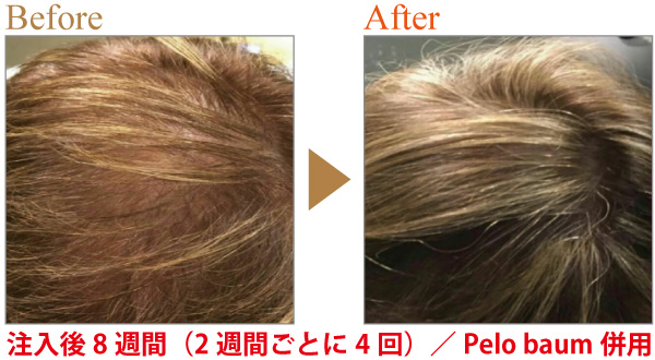 ヘアフィラー治療症例1