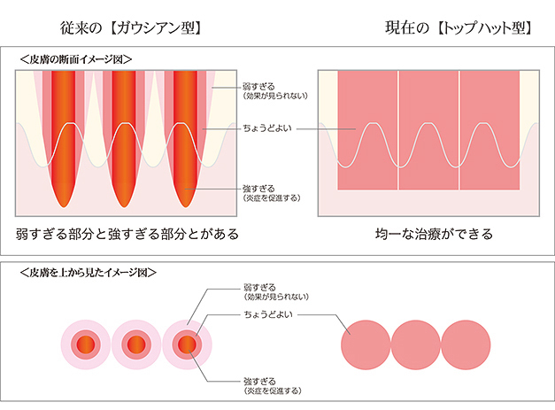 肝斑(かんぱん)治療