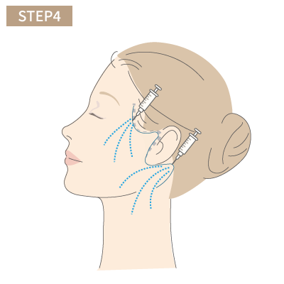 ひきつれたりしないよう生体ノリで固定して皮膚を切除