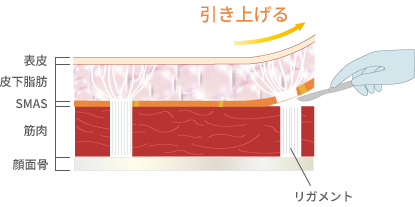 切開したところから、皮下脂肪の厚さで筋肉と皮膚を剥離する