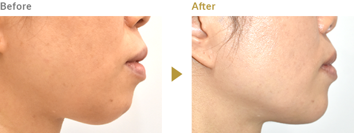 あごのヒアルロン酸注射