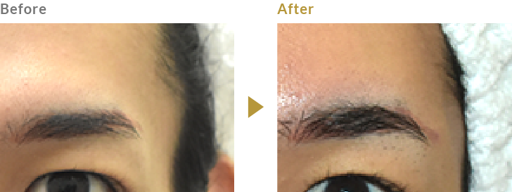 こめかみのヒアルロン酸注射