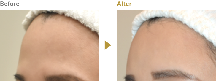 額のヒアルロン酸注射