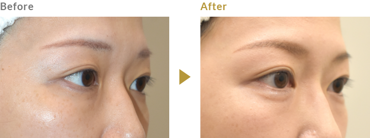 涙袋のヒアルロン酸注射