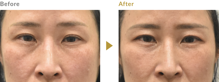 ゴルゴラインのヒアルロン酸注射