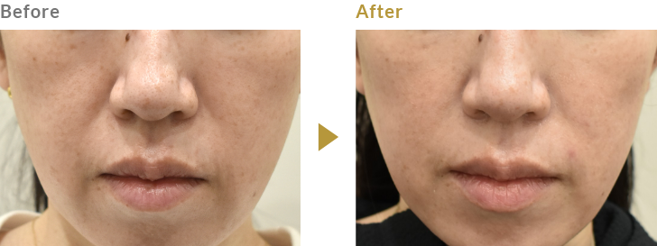 ほうれい線のヒアルロン酸注射