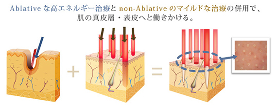 Ablativeな高エネルギー治療とnon-Ablativeのマイルドな治療の併用で、肌の真皮層・表皮へと働きかける。