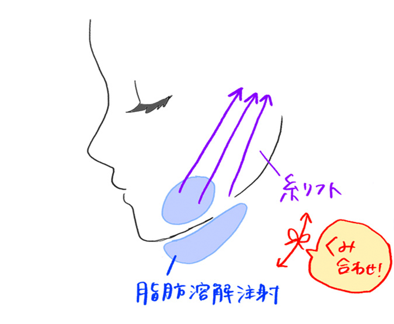 脂肪溶解注射
