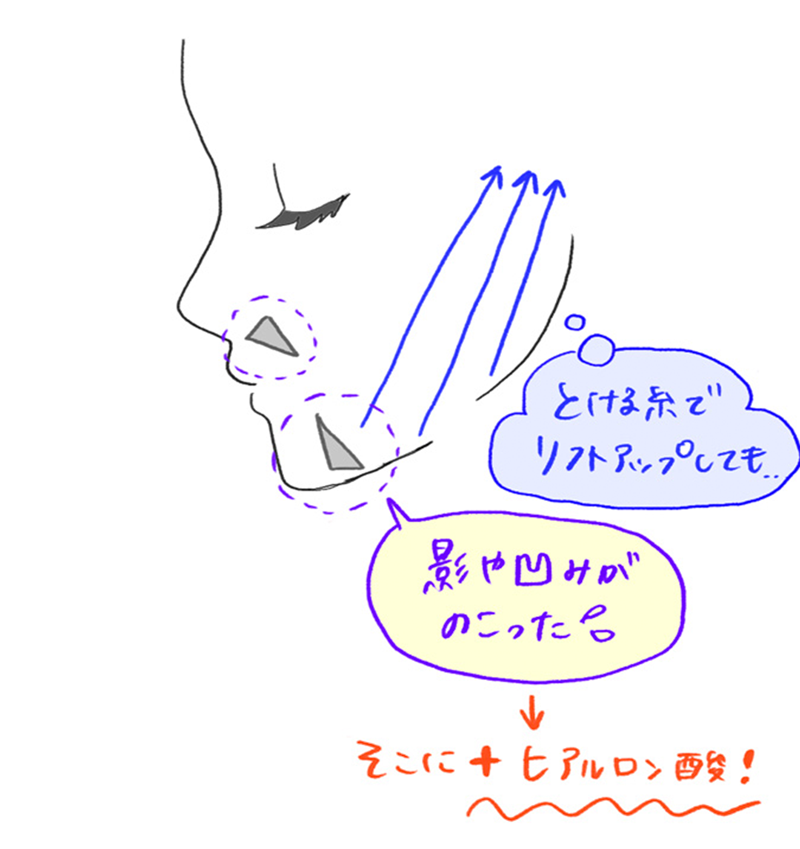 ヒアルロン酸注入