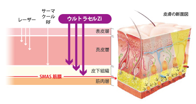 ウルトラセルZi（HIFU）＜ボディ＞