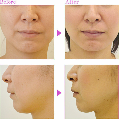 脂肪溶解小顔注射 Bnls の施術 銀座の美容整形外科 美容皮膚科ならノエル銀座クリニック 公式